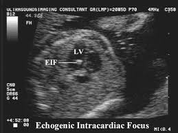 EIF ultrasound 3