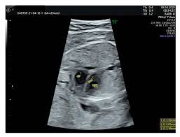 EIF ultrasound 2