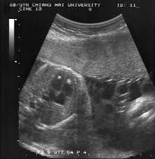 EIF ultrasound 1