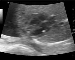 EIF ultrasound 4