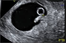 [Ultrasound] ตั้งครรภ์ 6 สัปดาห์