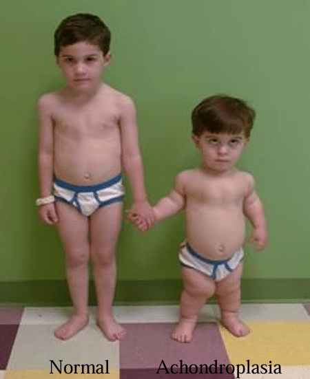 Achondroplasia